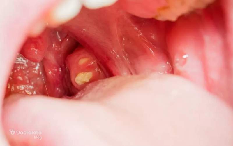 سنگ لوزه چه تفاوتی با سرطان لوزه دارد؟