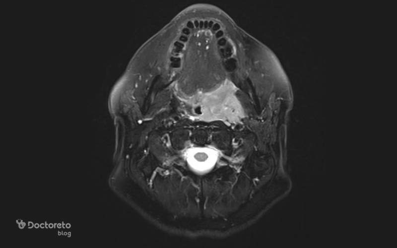 تصویربرداری از سرطان لوزه چگونه است؟