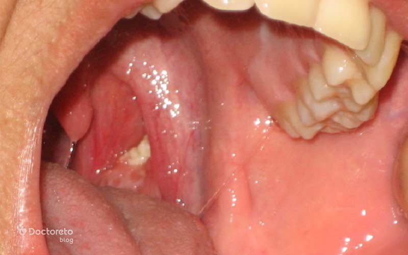 سنگ لوزه تودههای کوچک و سفتی هستند.