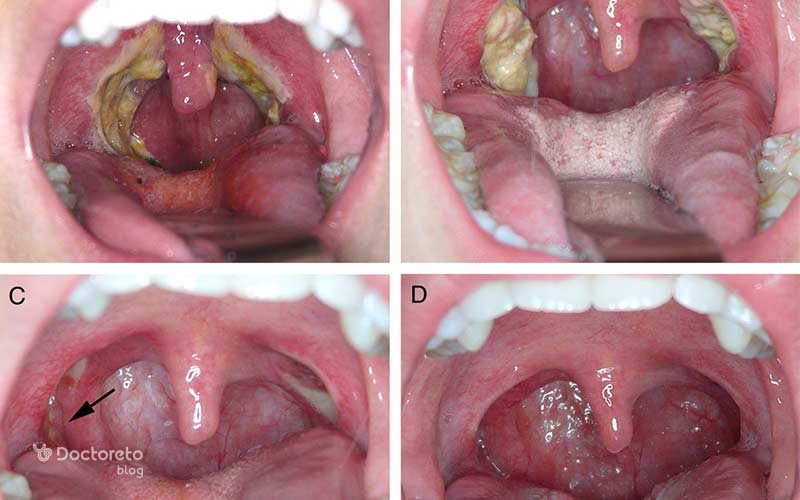 ترشحات بعد جراحی لوزه طبیعی است.