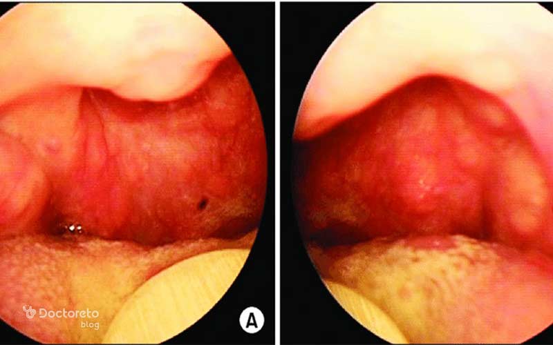بزرگی لوزه تنفس یا بلع را دشوار می کند.