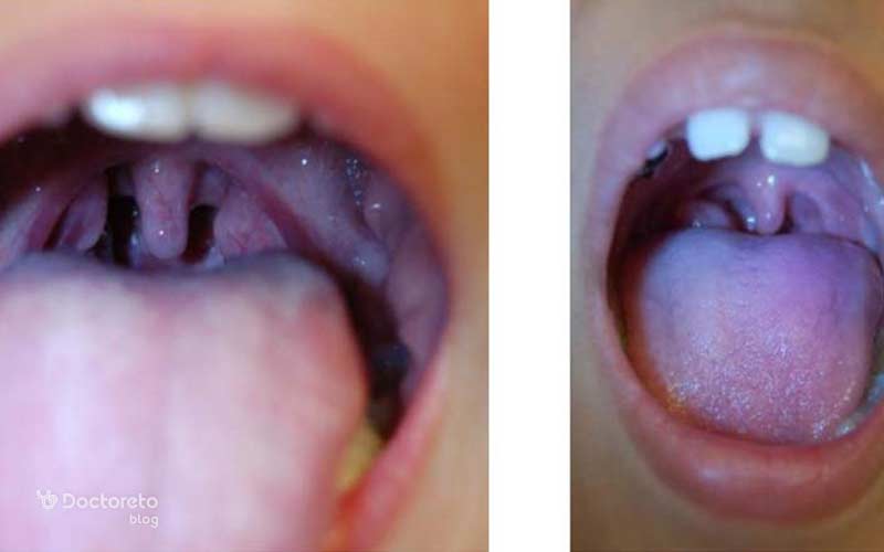 لوزههای بزرگشده به صورت تودههای متورم در پشت گلو هستند.