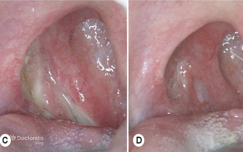 لایه سفید رنگ بعد جراحی لوزه به مرور از بین می رود.