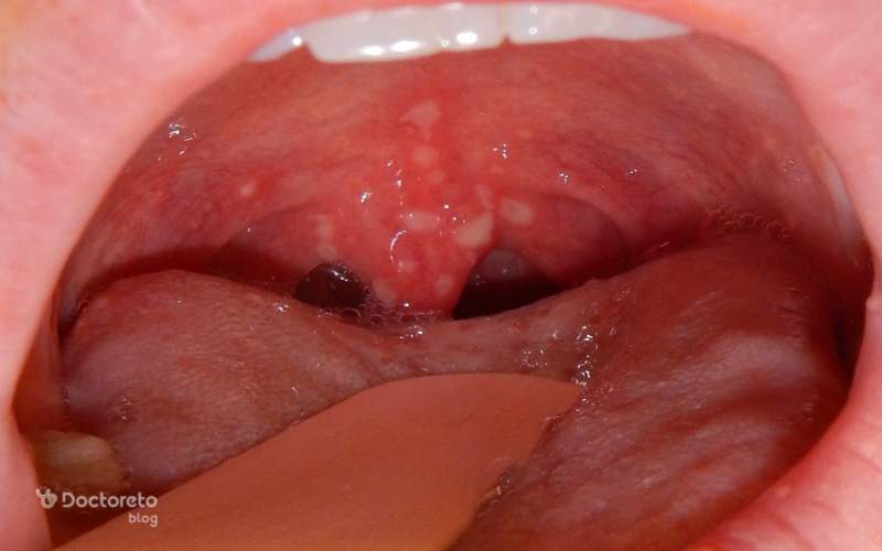 عکس سرطان لوزه در مراحل اولیه چگونه است؟