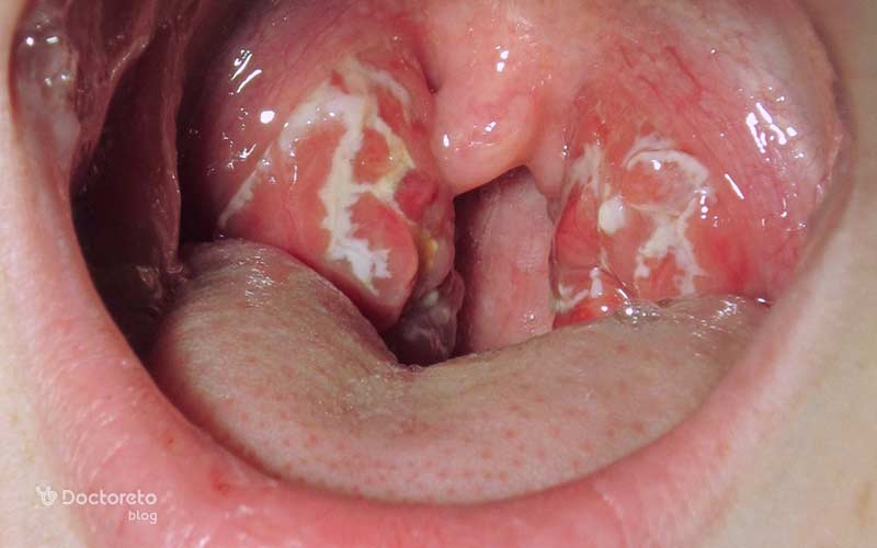 ظاهر سفید یا زرد رنگ از علائم لوزه چرکی است.